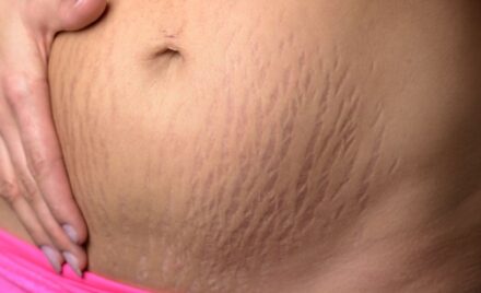 stretch Marks