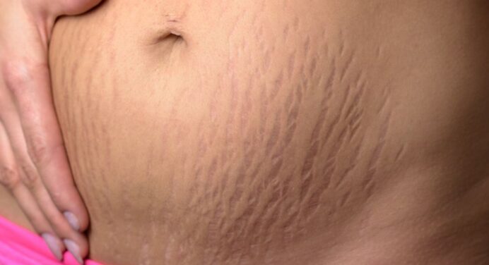 How to Choose the Right Stretch Mark Treatment for You