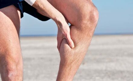 varicose veins