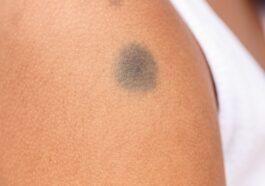 vascular birthmarks