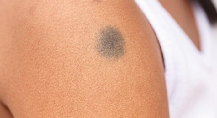 Birthmarks: types and treatments