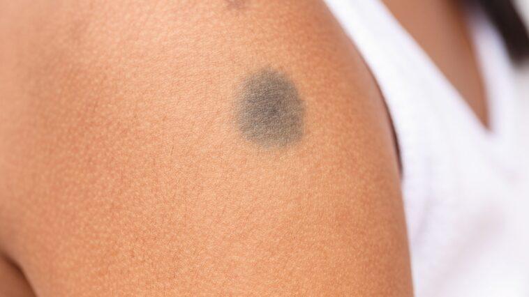 Birthmarks: types and treatments vascular birthmarks