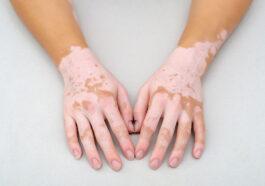 vitiligo research