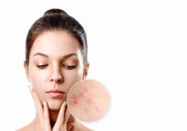 young woman with acne skin zoom circle young girl beauty portrait close up