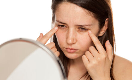 dark circles