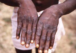 monkeypox scaled