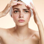 0000s 0003 What is acne  How to treat it and when