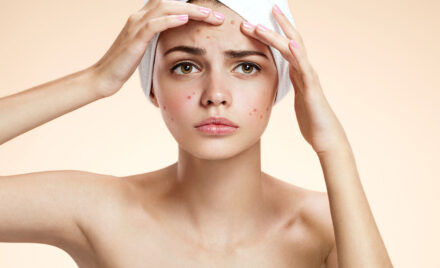 0000s 0003 What is acne How to treat it and when