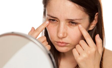 Blepharoplasty