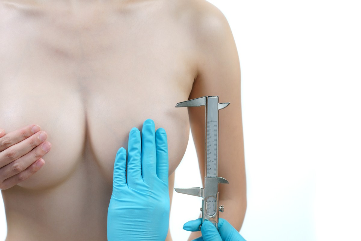 Breast asymmetry