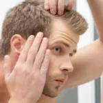 baldness 625x350 61446100539