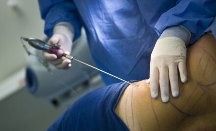 liposuction