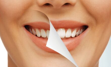 teeth whitening